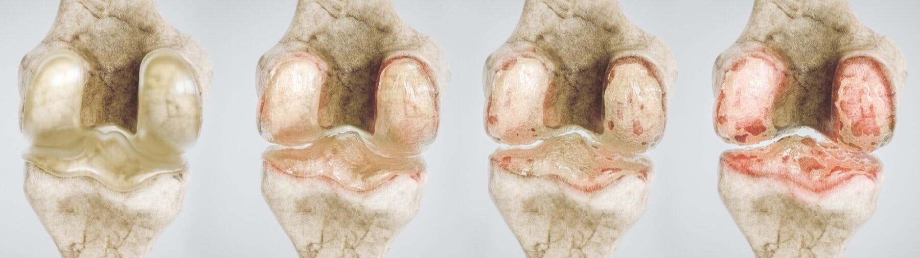 four stages of osteoarthritis of the knee