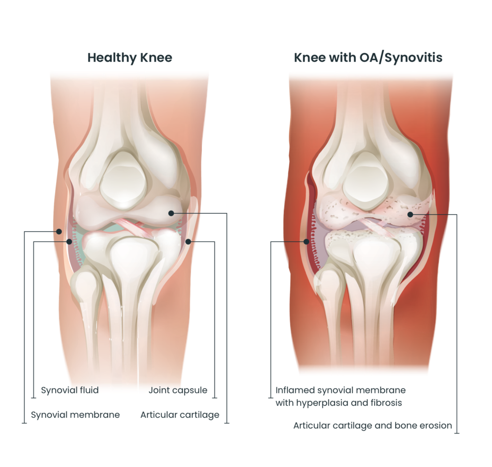 Healthy knee vs oa knee