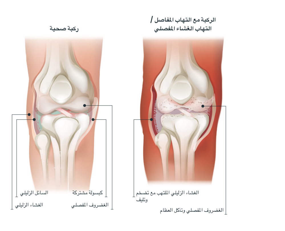 Knee compare ar