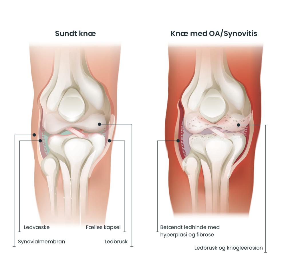 Knee compare dk