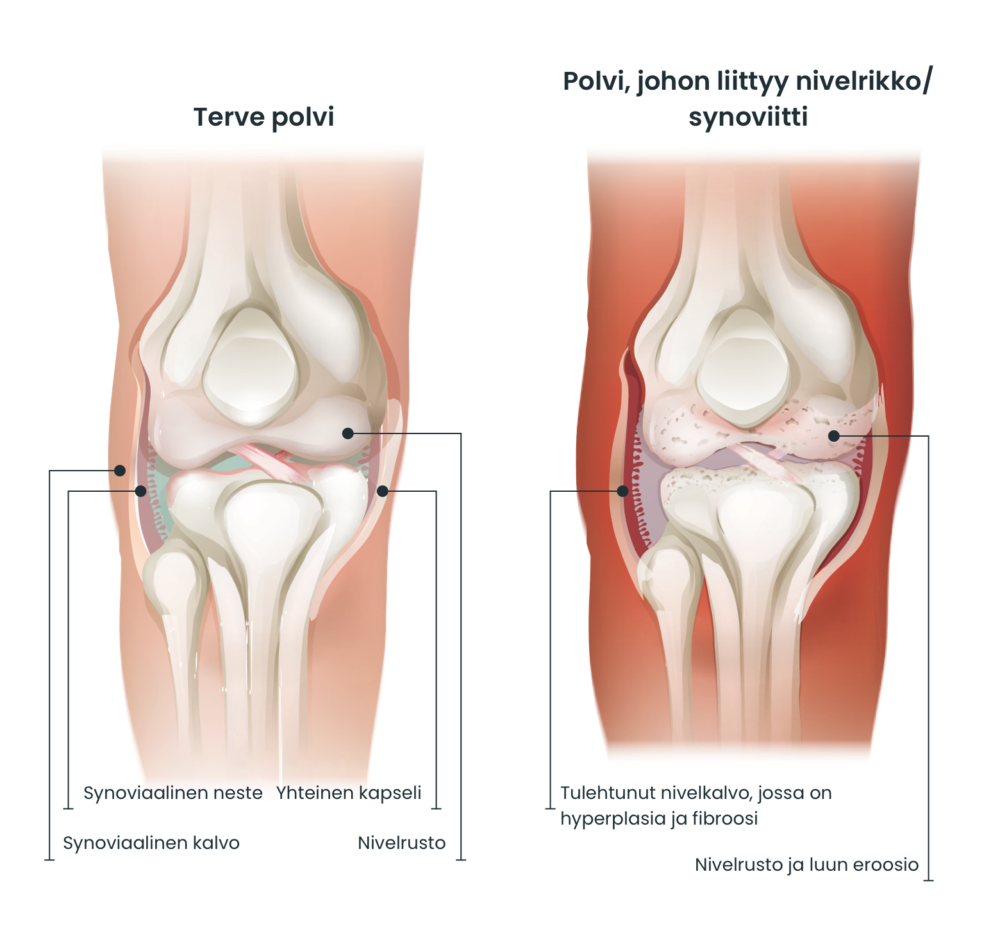 Knee compare fi