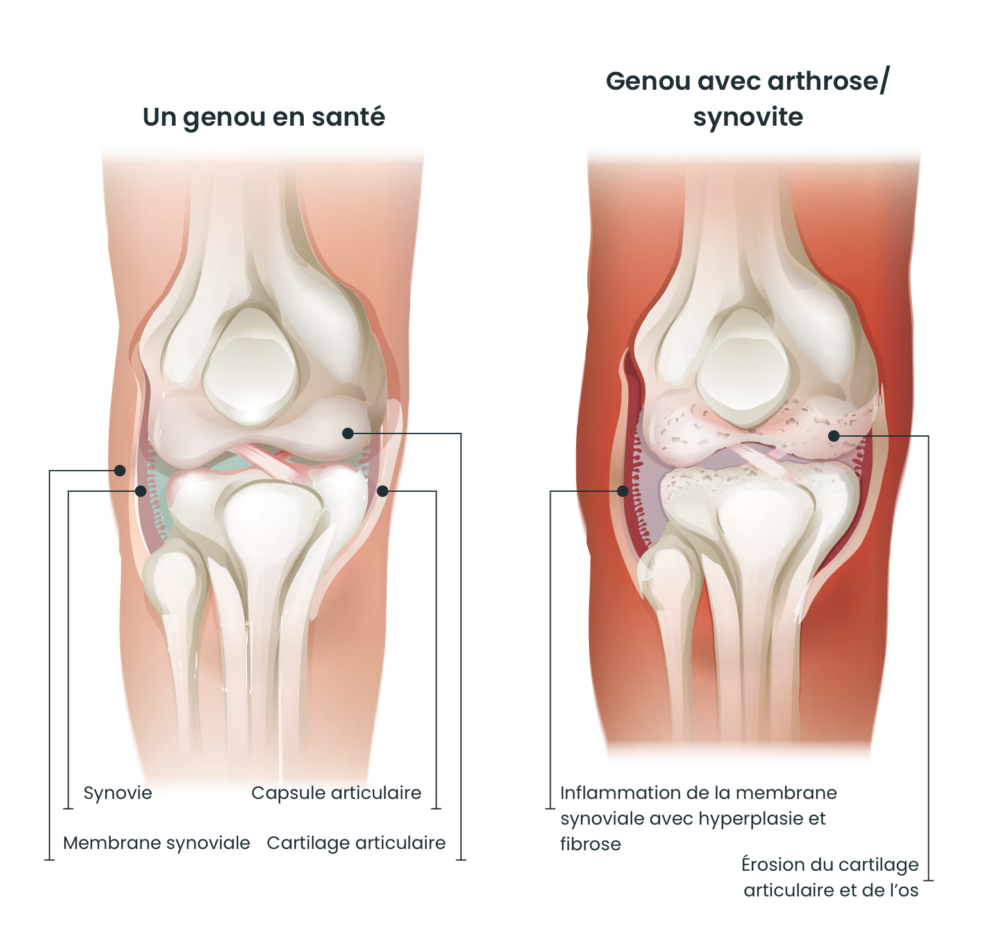 Knee compare fr