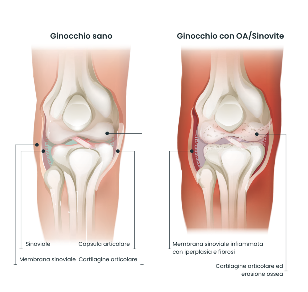 Knee compare it