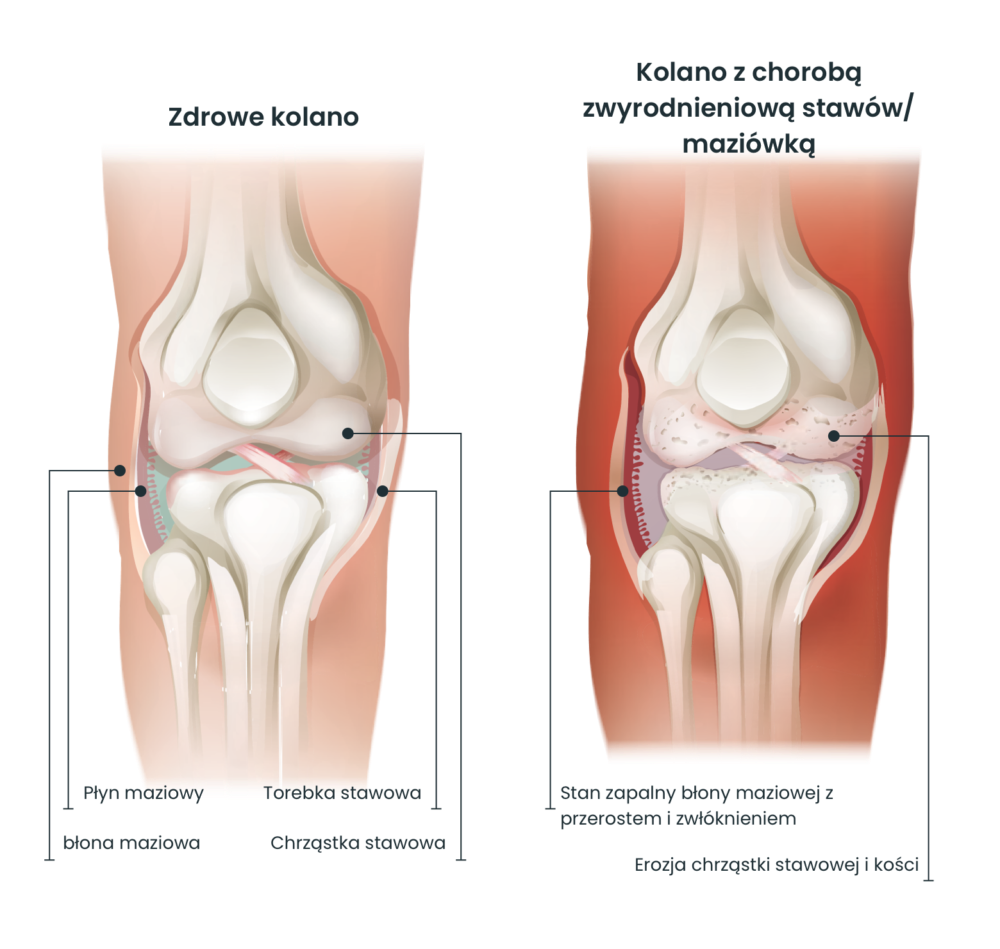 Knee compare pl