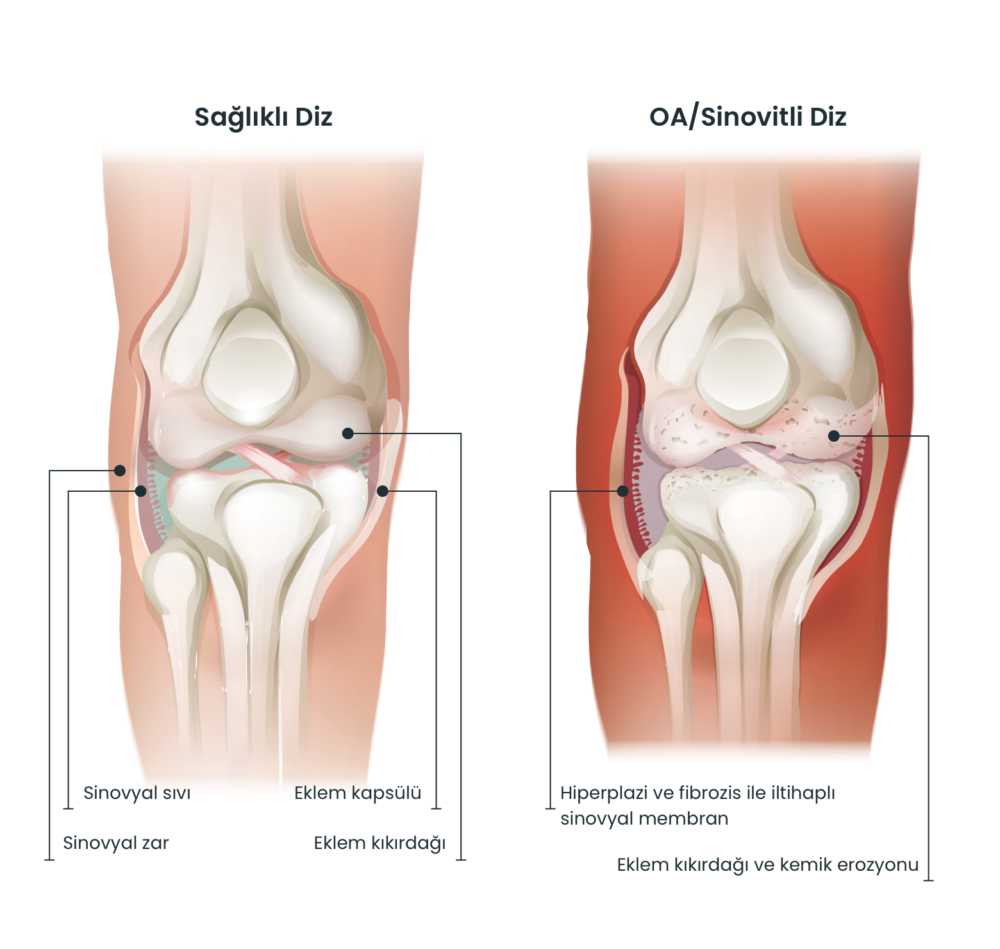 Knee compare tr