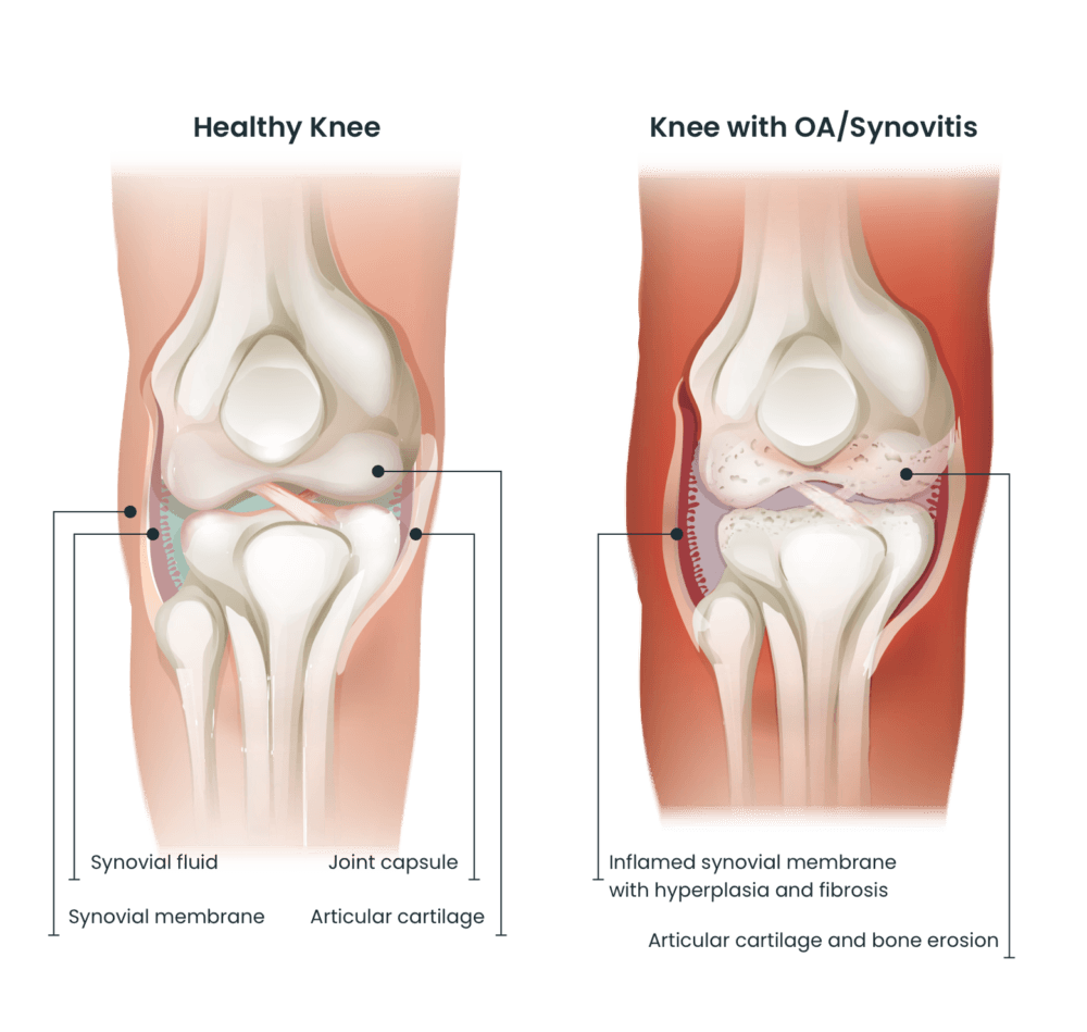 Healthy knee vs oa knee