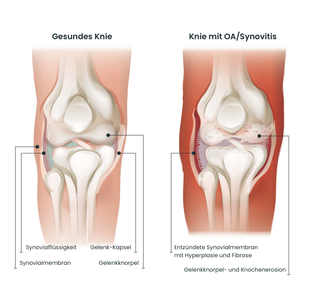 Knee compare de
