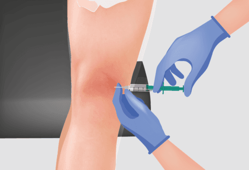 Arthrosamid - Arthrosamid®